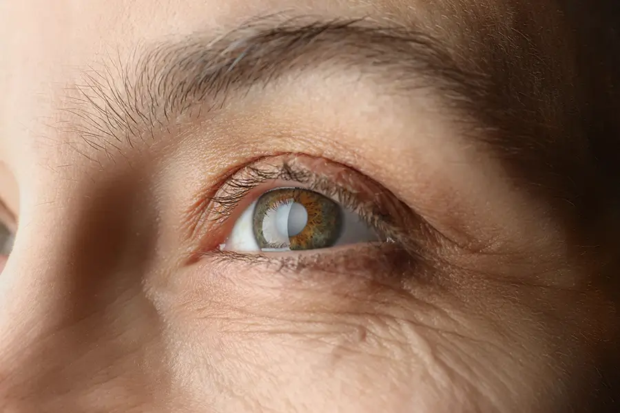 What are the Symptoms of Cataracts?