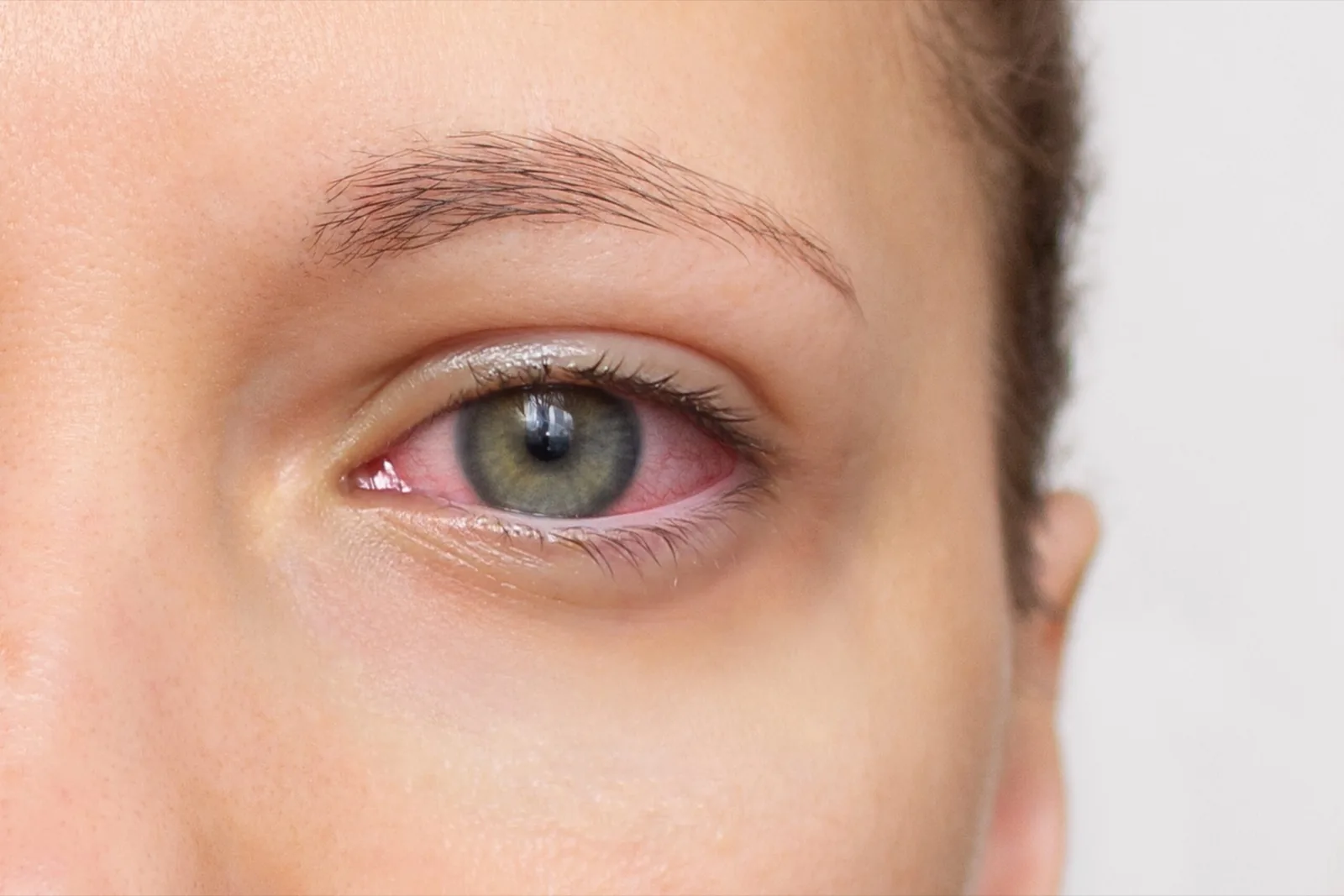 Why Are My Eyes Red? Common Causes Beyond Pink Eye