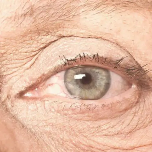 Macular Degeneration