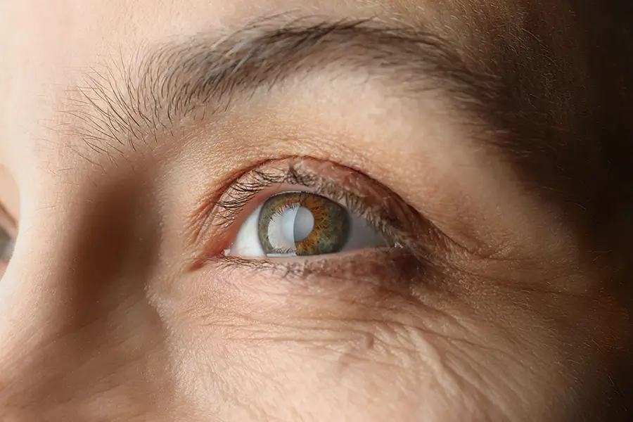 close up of an older woman with a cataract