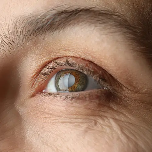 close up of eye with cataract