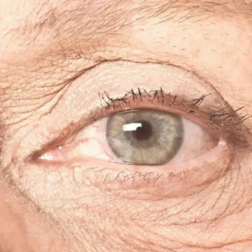 eye close up of woman with macular degeneration