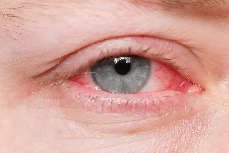 up close of pink eye in a female patient